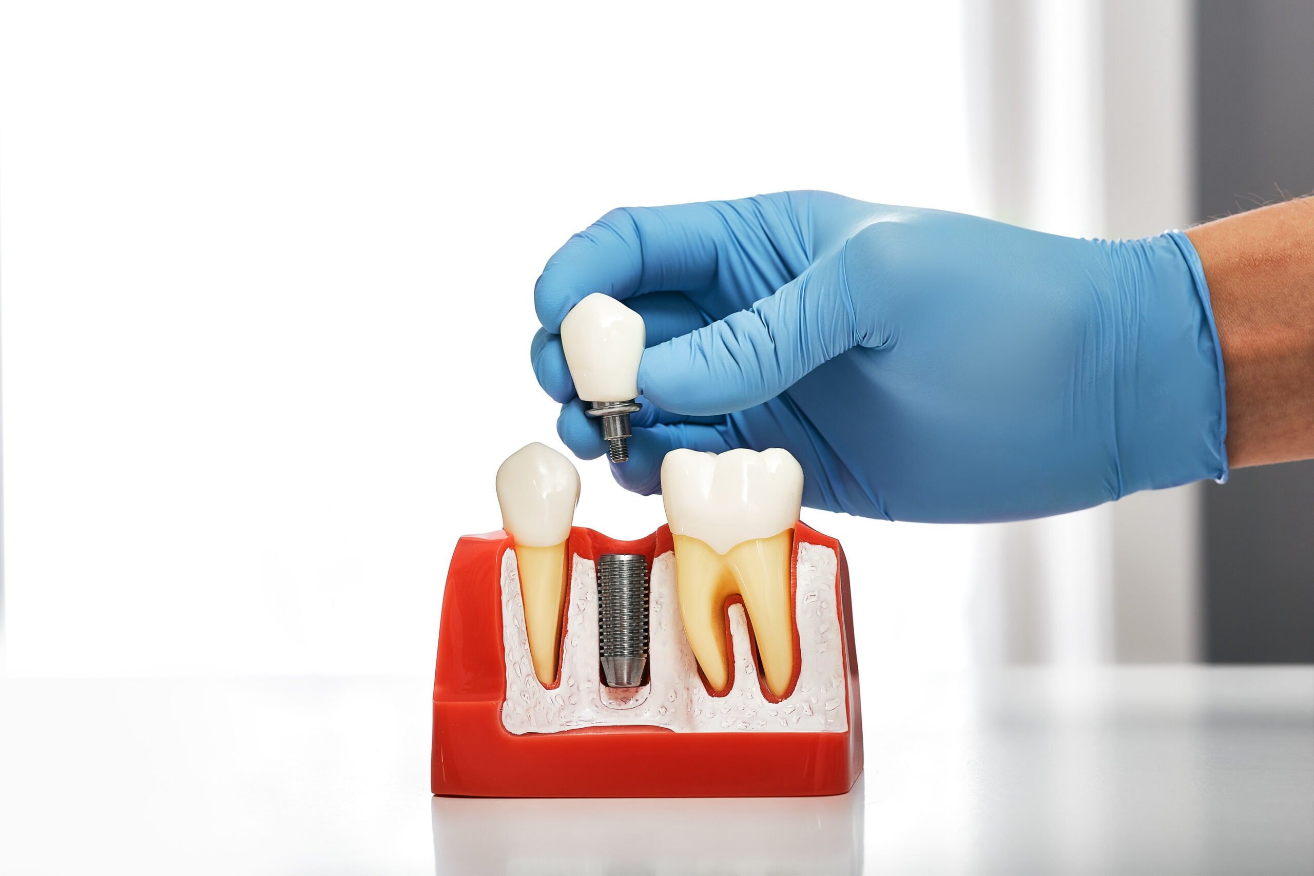 Dentist showing the installation of a dental implant on the anatomical model of teeth, close-up. Process of installing a dental implant