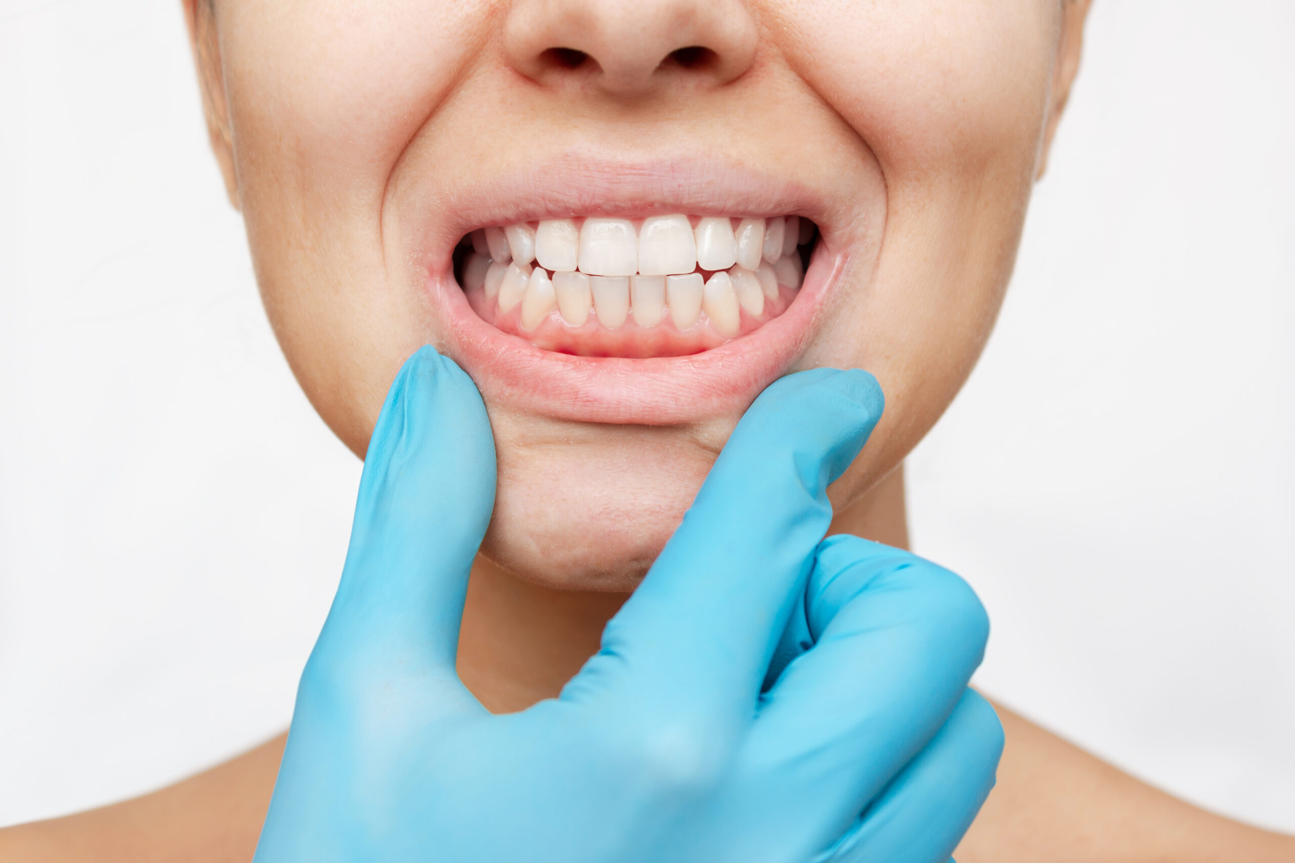Woman smiling showing healthy gums and teeth