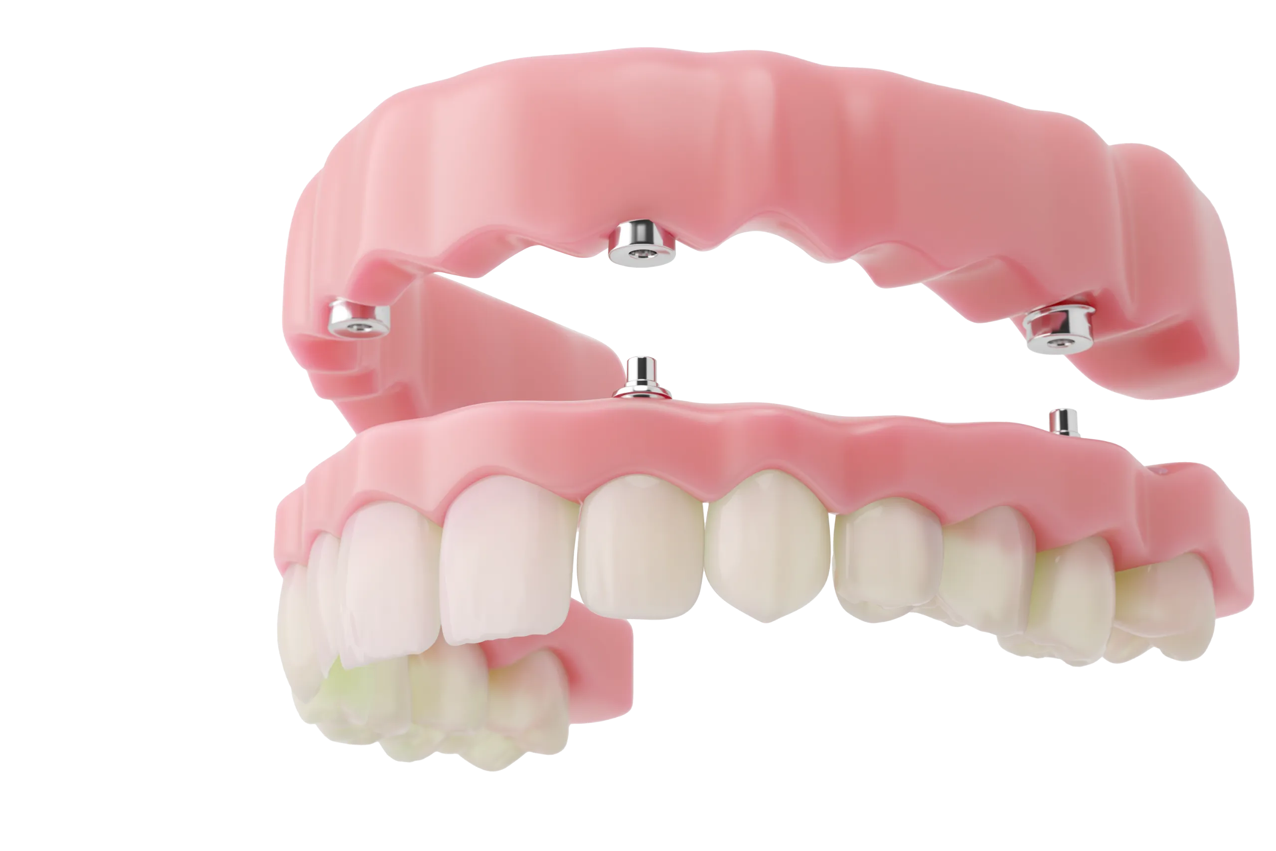 3D illustration of a full dental implant with fixed gum-supported prosthesis