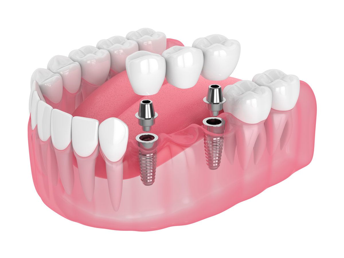 Dental implant model with teeth structure